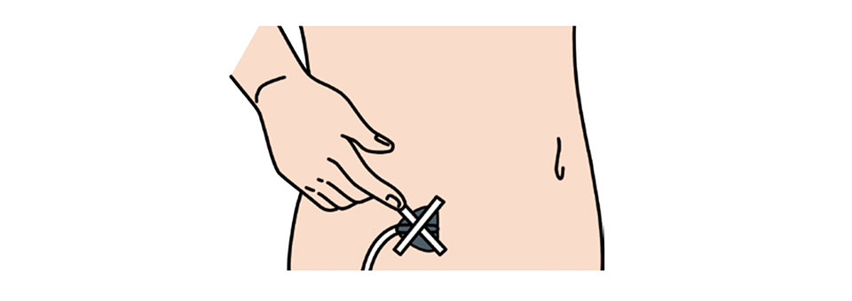 皮下へ針を刺入できたら、翼状針のうえからサージカルテープを斜めに交差するように貼りつけて翼状針がずれないように固定してください。