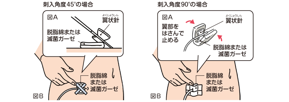 皮下へ針を刺入できたら、翼状針の下に脱脂綿または滅菌ガーゼを敷き（図A）、そのうえからサージカルテープを斜めに交差するように貼りつけて翼状針と脱脂綿または滅菌ガーゼがずれないように固定してください（図B）。