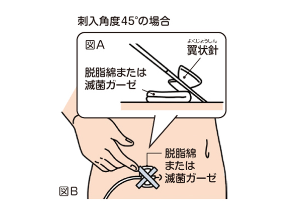 皮下へ針を刺入できたら、翼状針の下に脱脂綿または滅菌ガーゼを敷き（図A）、そのうえからサージカルテープを斜めに交差するように貼りつけて翼状針と脱脂綿または滅菌ガーゼがずれないように固定してください（図B）。