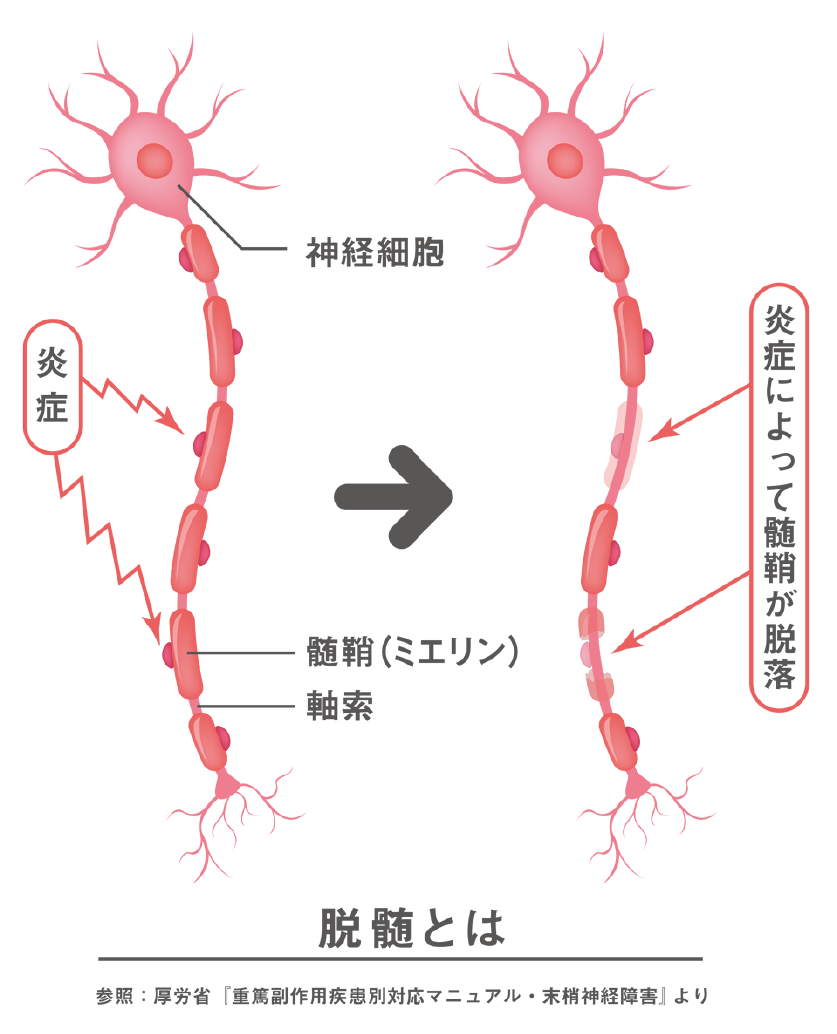 イラスト：脱髄が起こっているニューロン