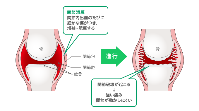 関節滑膜関節内出血のたびに細かな傷がつき、増殖・肥厚する　関節破壊が起こる→強い痛み関節が動かしにくい
