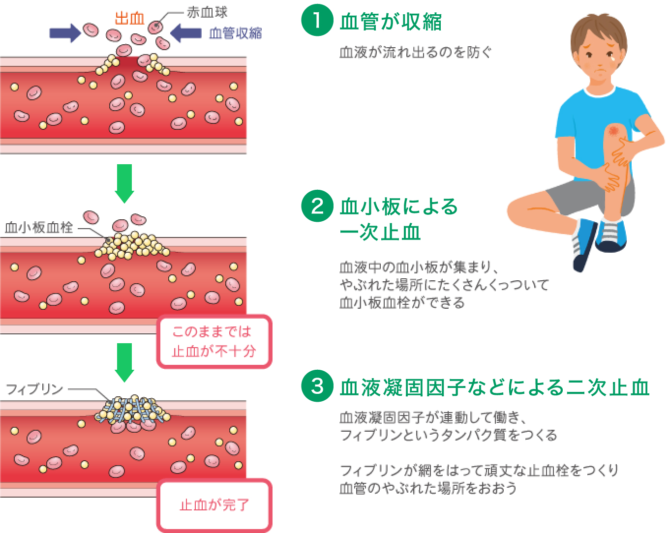 クローン病の消化管への影響